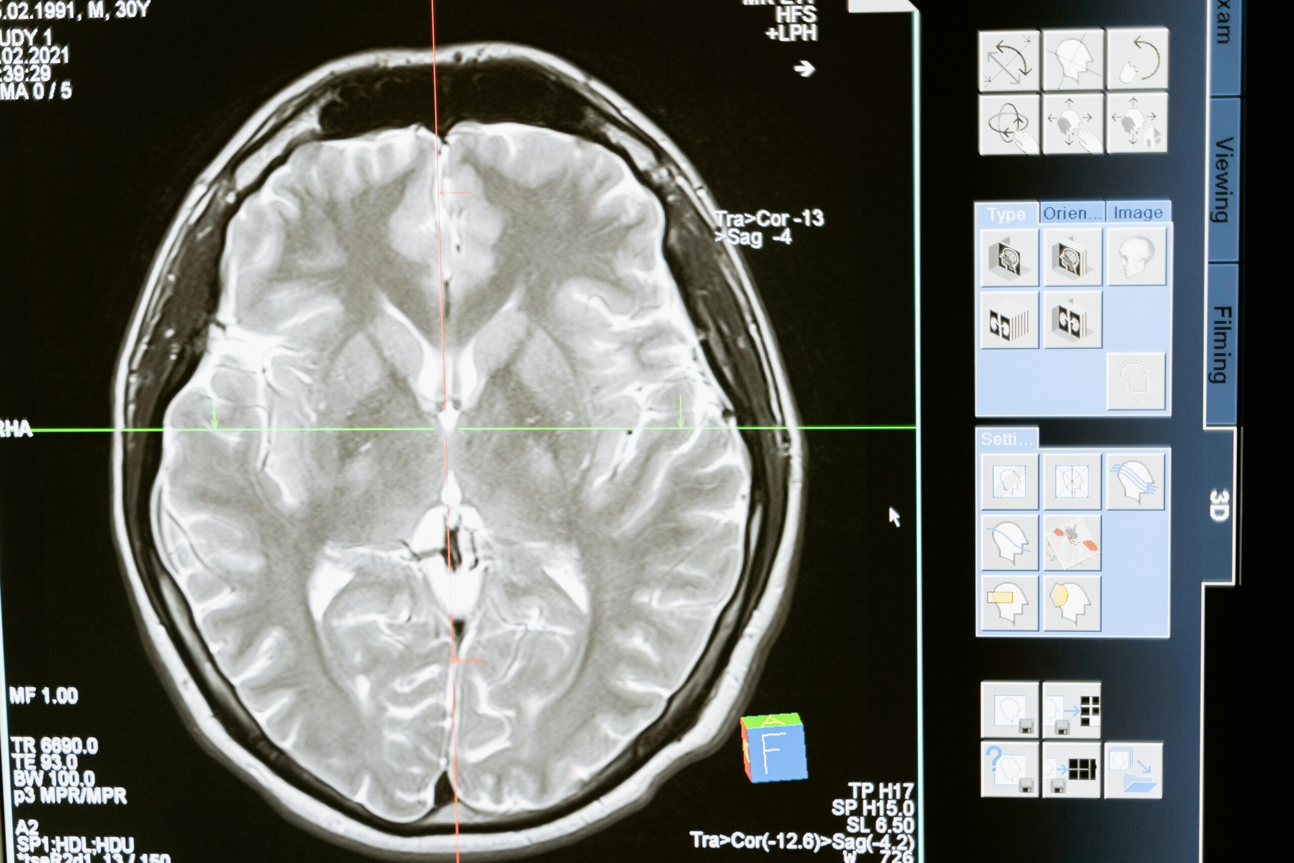 Fluid accumulation in the brain may lead to dementia in the elderly